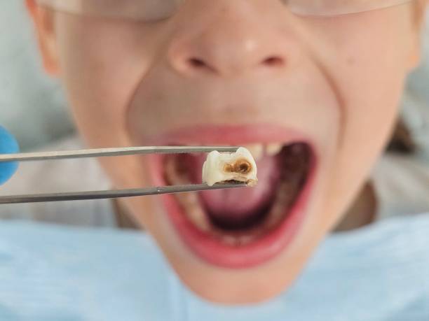 Best Emergency Treatment for Dental Infections or Abscesses in Luck, WI